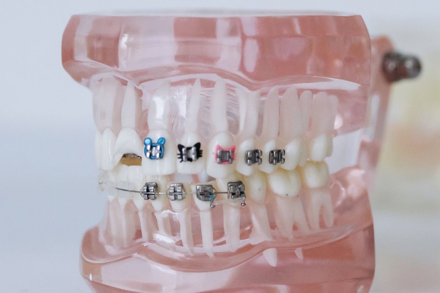 Modèle pédagogique de mâchoire en résine translucide portant un appareil multi-attaches : bagues métalliques reliées par un arc, avec des élastiques de couleur sur les dents du haut