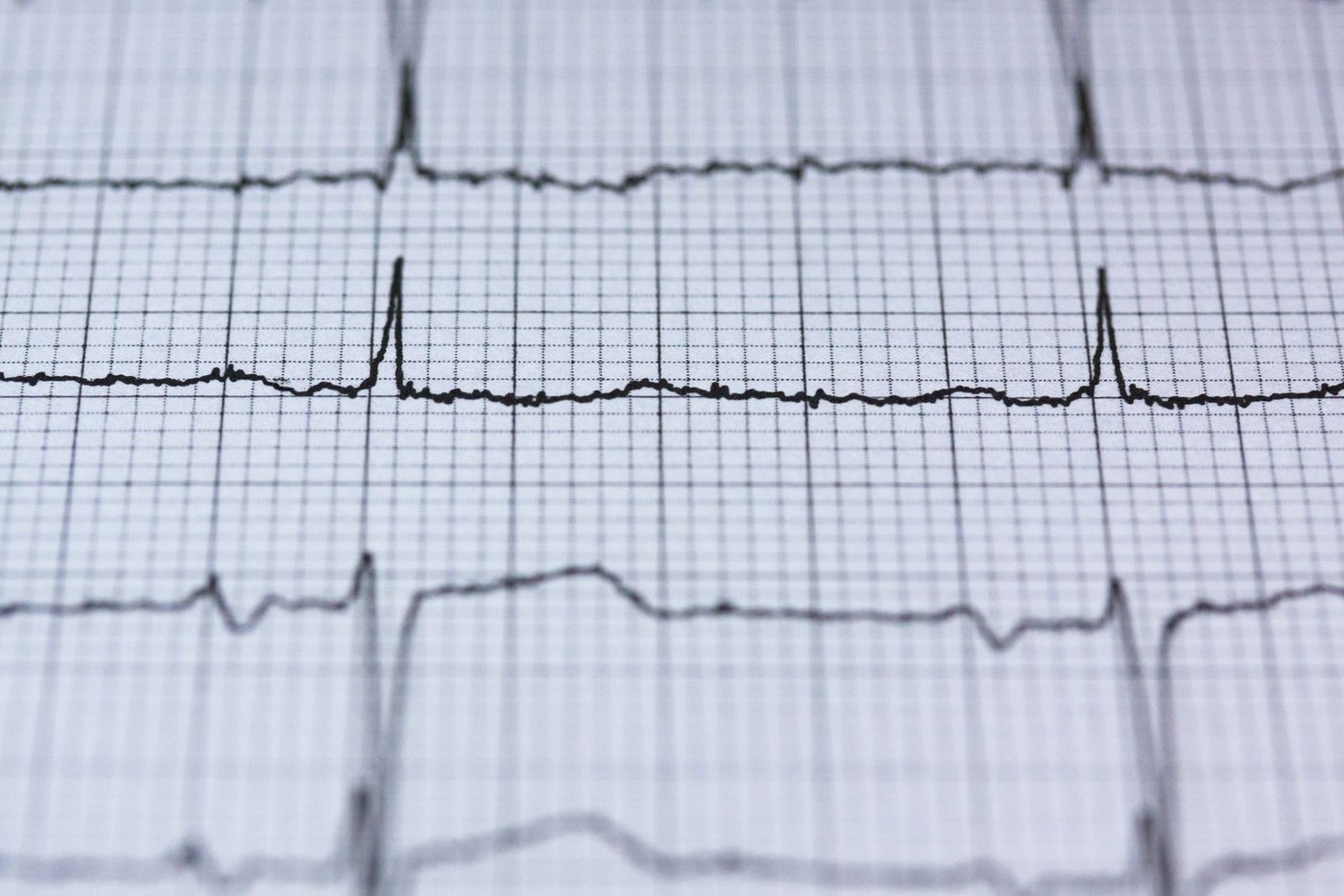 Tracé d'électrocardiogramme imprimé sur papier millimétré, montrant plusieurs dérivations du rythme cardiaque